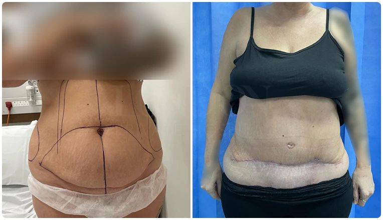 tummy tuck before and after-8-v1