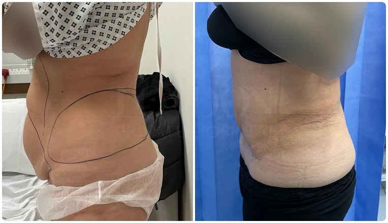 tummy tuck before and after-8-v3
