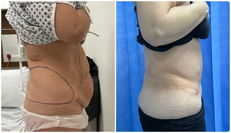 tummy tuck before and after-8-v4
