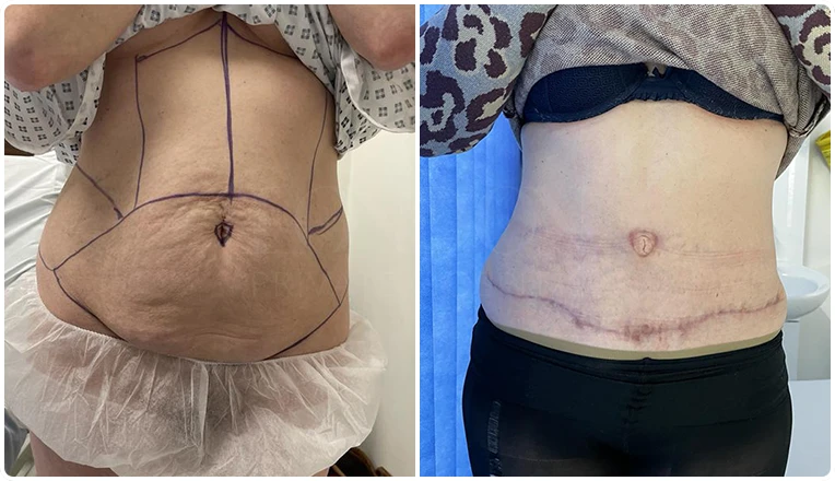 tummy tuck before and after result-1