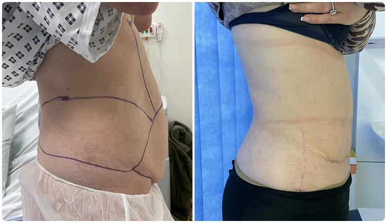 tummy tuck before and after result-2