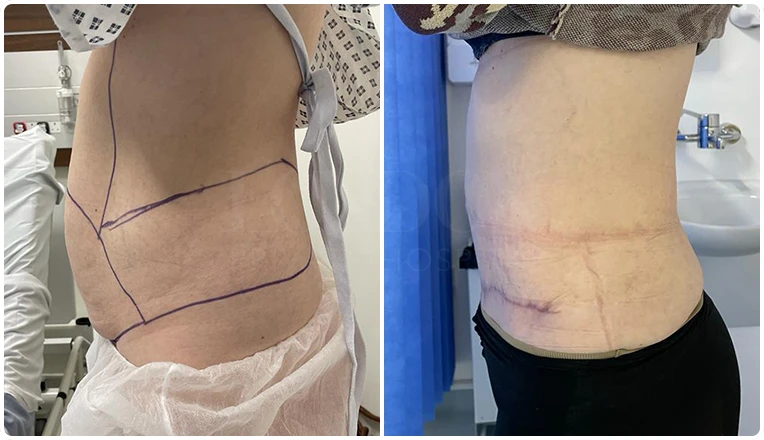 tummy tuck before and after result-3