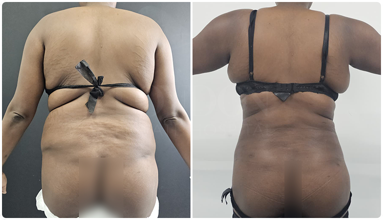back vaser liposuction before and after result