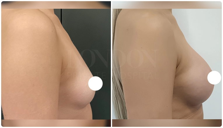 breast augmentation with smooth, round 300 cc high profile implants