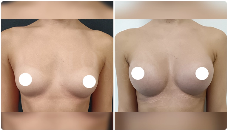 breast augmentation with smooth, round 300 cc high profile implants