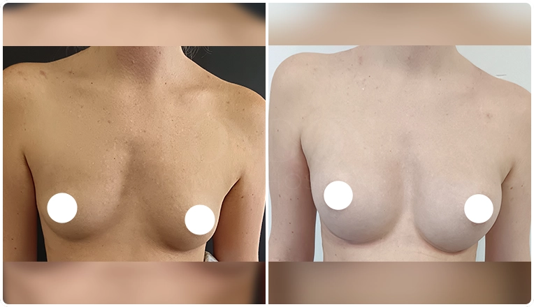 breast augmentation with smooth, round 350 cc high profile implants
