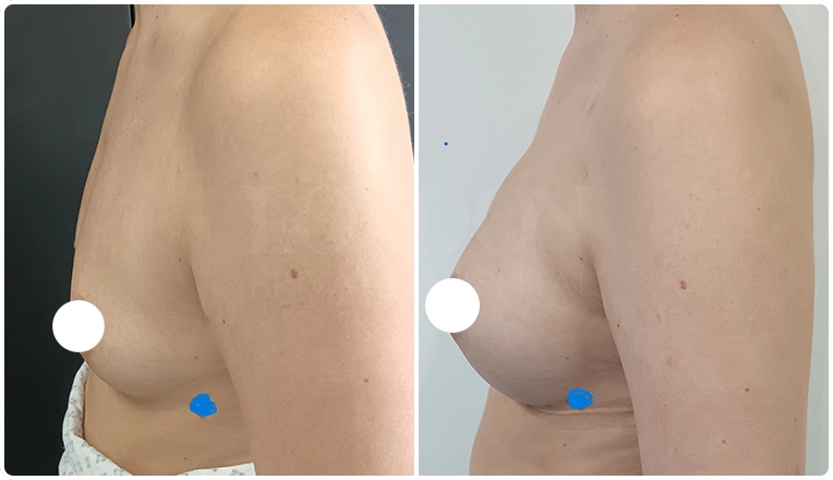 breast augmentation with smooth, round 350 cc high profile implants