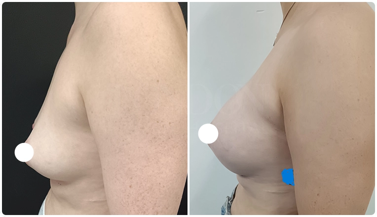 breast augmentation with smooth, round 350 cc high profile implants