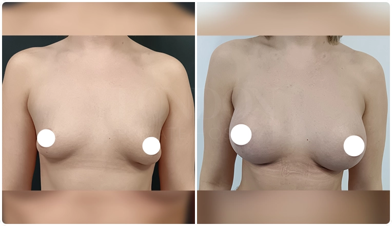 breast augmentation with smooth, round 375 cc high profile implants