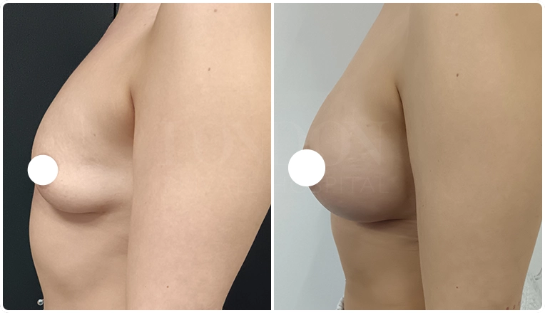 breast augmentation with smooth, round 375 cc high profile implants