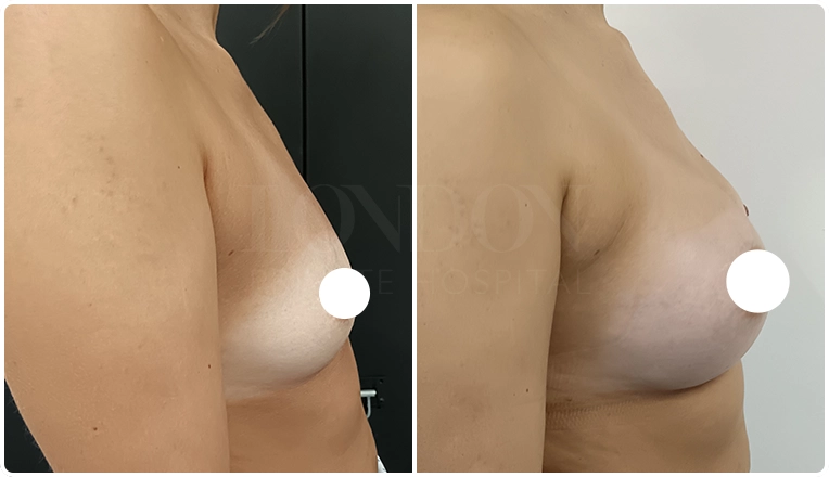 breast augmentation with smooth, round 400 cc high profile implants