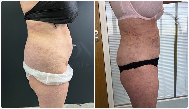 Flanks Vaser Liposuction Before and After Result