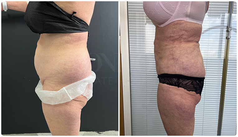 Flanks Vaser Liposuction Before and After Result