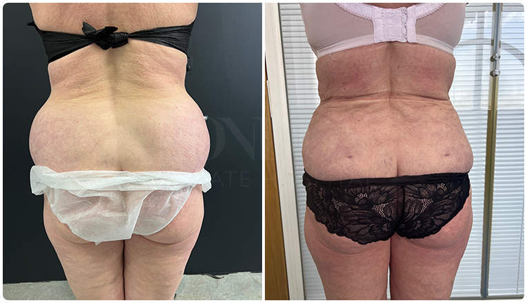 Flanks Vaser Liposuction Before and After Result
