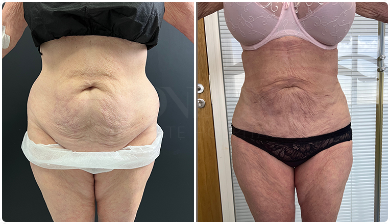 stomach vaser lipo before and after result