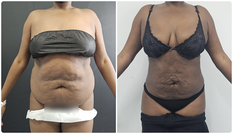 stomach vaser lipo before and after result