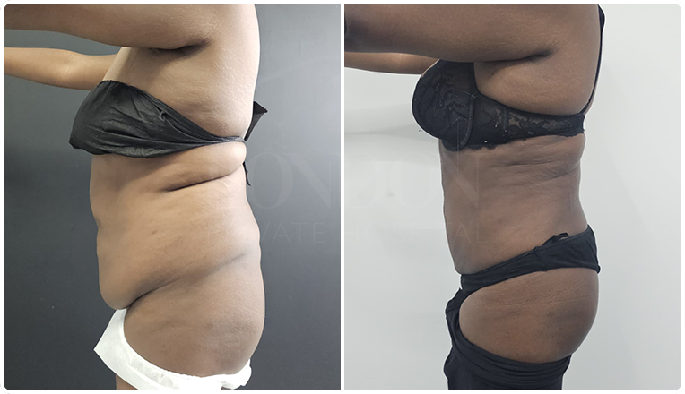 Vaser Liposuction on Abdomen & Flanks Result