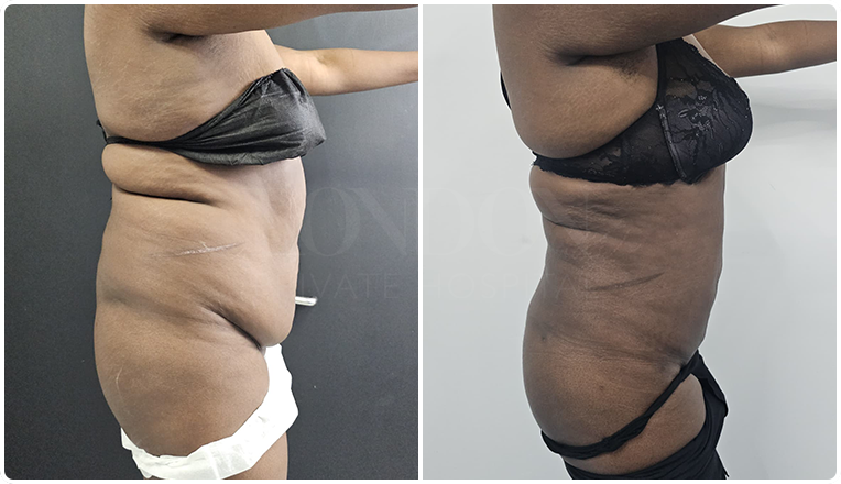 Vaser Liposuction on Abdomen & Flanks Result