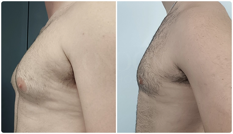 vaser liposuction and gland excision for Gynecomastia