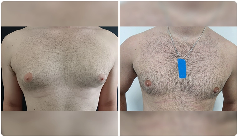 vaser liposuction and gland excision for Gynecomastia