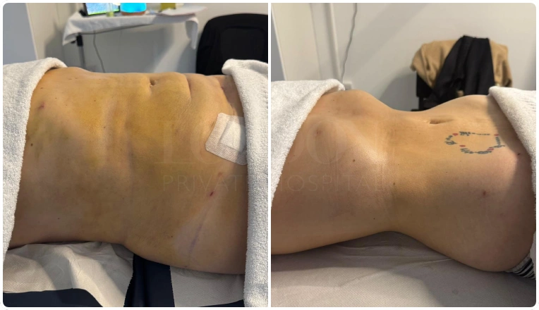 Results After 6 MLD Massages, Post op from Liposuction on Abdomen and Flanks