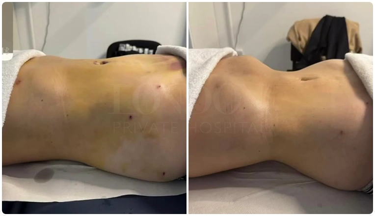 6 sessions of MLD after vaser liposuction on the abdomen and flanks result