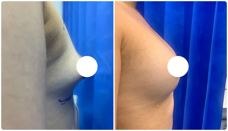tubular breast correction before and after result