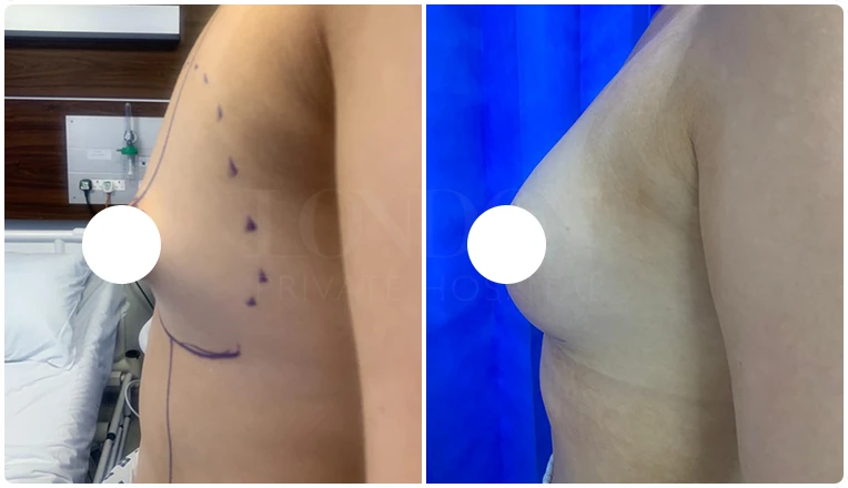 tubular breast correction before and after result
