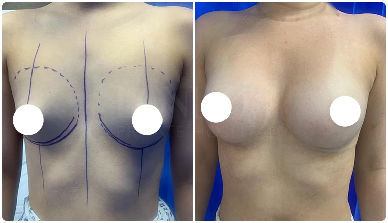 tubular breast correction before and after result