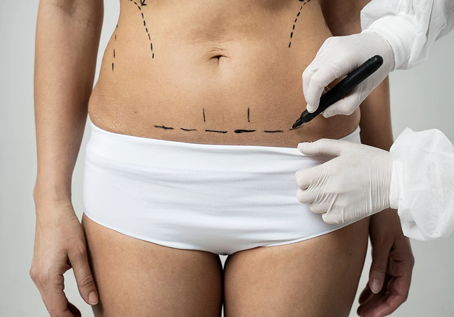 Tummy Tuck Recovery Time: A Week-by-Week Healing Guide