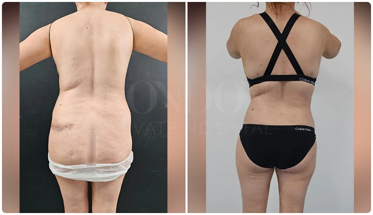 love handle liposuction before and after result
