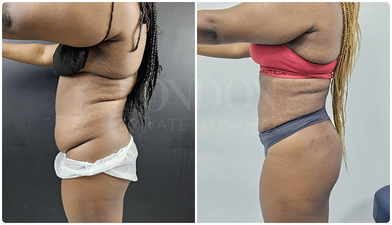 stomach liposuction before and after