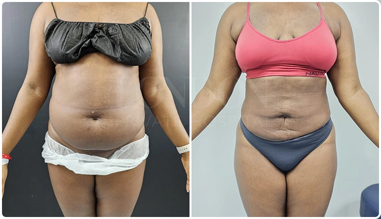 stomach liposuction before and after