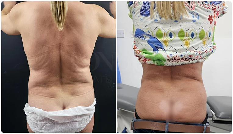 vaser liposuction before and after love handles result