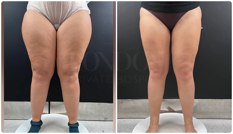 vaser liposuction legs before after result