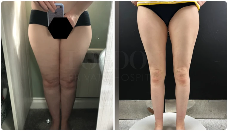vaser liposuction legs before after result