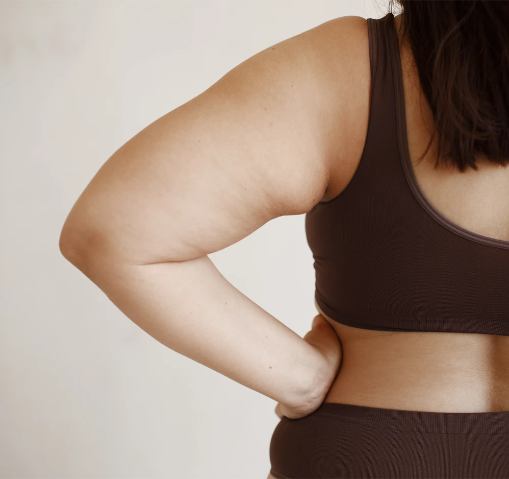 Woman showing disproportionate upper-arm fullness associated with possible lipoedema