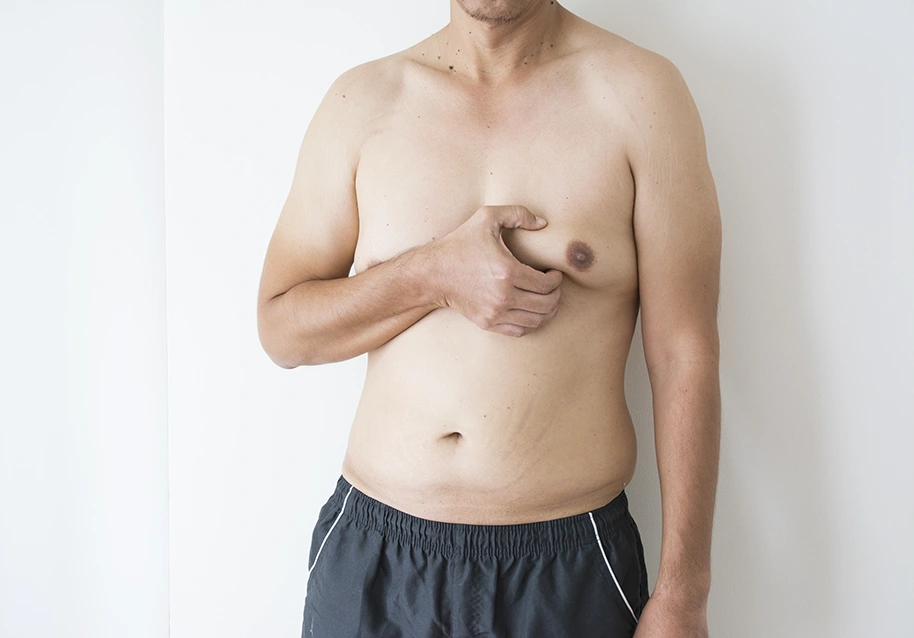 What Causes Gynecomastia in Men?