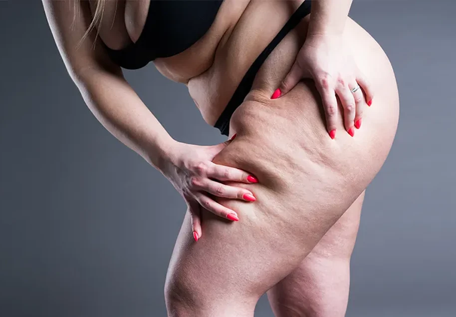 Lipoedema Stages 1–3: Early Signs and Progression Explained